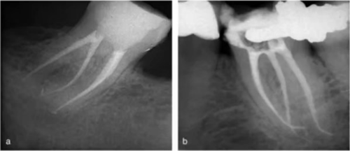 宇森SC-Pro鎳鈦根管銼|宇森醫(yī)療根管治療器械領(lǐng)跑者 宇森SC-Pro鎳鈦根管銼|宇森醫(yī)療根管治療器械領(lǐng)跑者