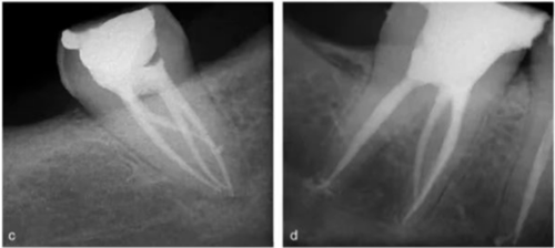 宇森SC-Pro鎳鈦根管銼|宇森醫(yī)療根管治療器械領(lǐng)跑者 宇森SC-Pro鎳鈦根管銼|宇森醫(yī)療根管治療器械領(lǐng)跑者