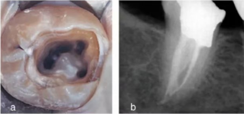 宇森SC-Pro鎳鈦根管銼|宇森醫(yī)療根管治療器械領(lǐng)跑者 宇森SC-Pro鎳鈦根管銼|宇森醫(yī)療根管治療器械領(lǐng)跑者