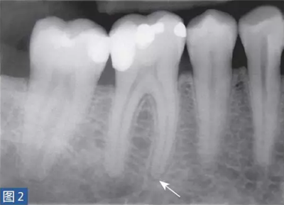 根尖周炎的病因與癥狀 根尖周炎的病因與癥狀