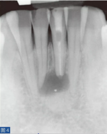 根尖周炎的病因與癥狀 根尖周炎的病因與癥狀