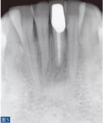 根尖周炎的病因與癥狀 根尖周炎的病因與癥狀