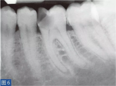 根尖周炎的病因與癥狀 根尖周炎的病因與癥狀