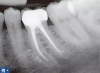 根尖周炎的病因與癥狀 根尖周炎的病因與癥狀