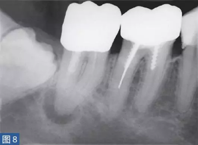 根尖周炎的病因與癥狀 根尖周炎的病因與癥狀