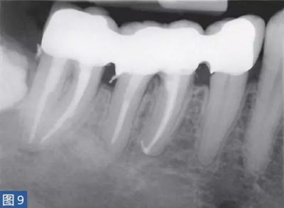 根尖周炎的病因與癥狀 根尖周炎的病因與癥狀