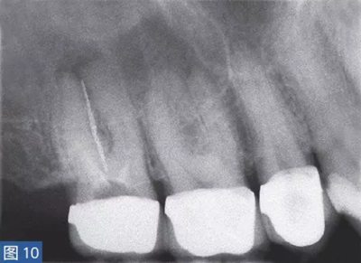 根尖周炎的病因與癥狀 根尖周炎的病因與癥狀