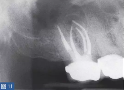 根尖周炎的病因與癥狀 根尖周炎的病因與癥狀