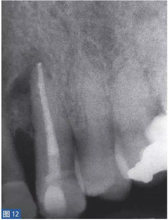 根尖周炎的病因與癥狀 根尖周炎的病因與癥狀