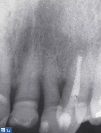 根尖周炎的病因與癥狀 根尖周炎的病因與癥狀