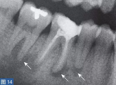 根尖周炎的病因與癥狀 根尖周炎的病因與癥狀