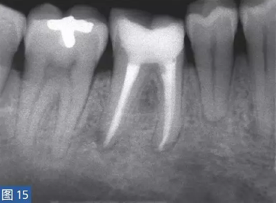 根尖周炎的病因與癥狀根尖周炎的病因與癥狀 根尖周炎的病因與癥狀根尖周炎的病因與癥狀