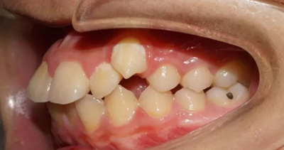 正畸矯正 正畸矯正