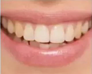 瓷貼面修復(fù)體最終顏色的影響因素 瓷貼面修復(fù)體最終顏色的影響因素