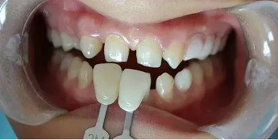 瓷貼面修復(fù)體最終顏色的影響因素 瓷貼面修復(fù)體最終顏色的影響因素