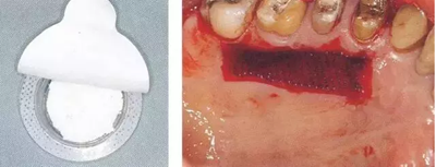 【牙周外科的基本技術技能】術后管理 【牙周外科的基本技術技能】術后管理