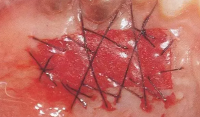 【牙周外科的基本技術技能】術后管理 【牙周外科的基本技術技能】術后管理