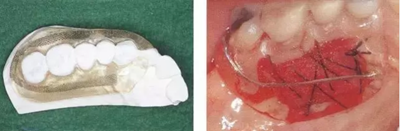 【牙周外科的基本技術技能】術后管理 【牙周外科的基本技術技能】術后管理