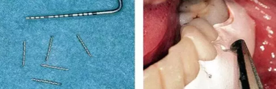 【牙周外科的基本技術技能】術后管理 【牙周外科的基本技術技能】術后管理