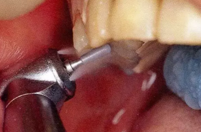 【牙周外科的基本技術技能】術后管理 【牙周外科的基本技術技能】術后管理