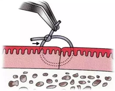 【牙周外科的基本技術技能】術后管理 【牙周外科的基本技術技能】術后管理