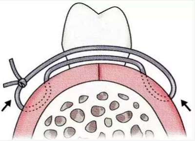 【牙周外科的基本技術技能】術后管理 【牙周外科的基本技術技能】術后管理