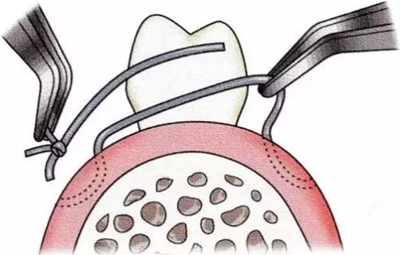 【牙周外科的基本技術技能】術后管理 【牙周外科的基本技術技能】術后管理