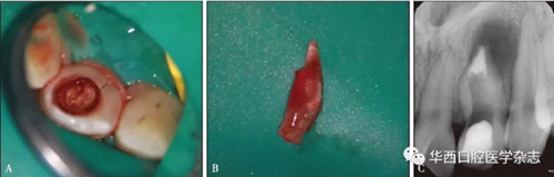根尖屏障技術(shù)治療Ⅱ型牙內(nèi)陷引發(fā)慢性根尖周炎1例 根尖屏障技術(shù)治療Ⅱ型牙內(nèi)陷引發(fā)慢性根尖周炎1例
