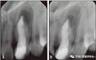 根尖屏障技術(shù)治療Ⅱ型牙內(nèi)陷引發(fā)慢性根尖周炎1例 根尖屏障技術(shù)治療Ⅱ型牙內(nèi)陷引發(fā)慢性根尖周炎1例