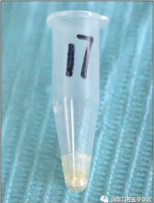 根管預備系統 根管預備系統