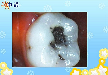 齲病診斷和鑒別診斷 齲病診斷和鑒別診斷