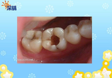 齲病診斷和鑒別診斷 齲病診斷和鑒別診斷