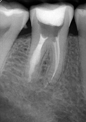 內(nèi)吸收 內(nèi)吸收