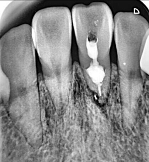 內(nèi)吸收 內(nèi)吸收