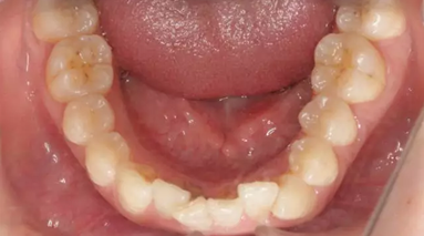 鄰面去釉技術(shù)詳解 鄰面去釉技術(shù)詳解