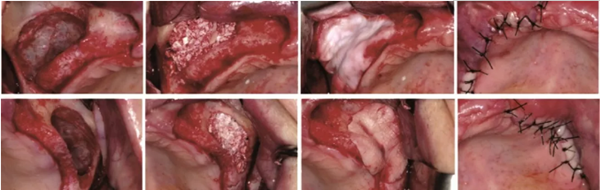 CGF/PRF作為屏障膜使用 CGF/PRF作為屏障膜使用