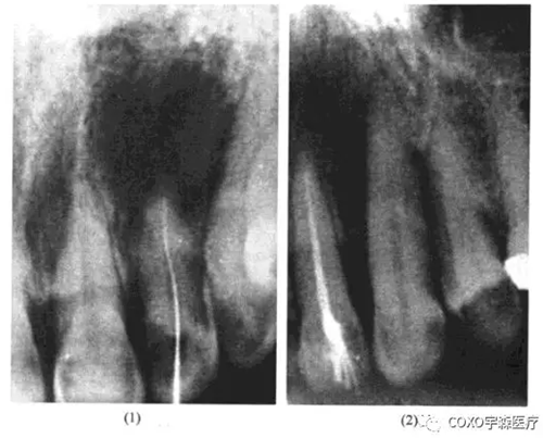 根尖周病的鑒別診斷 根尖周病的鑒別診斷