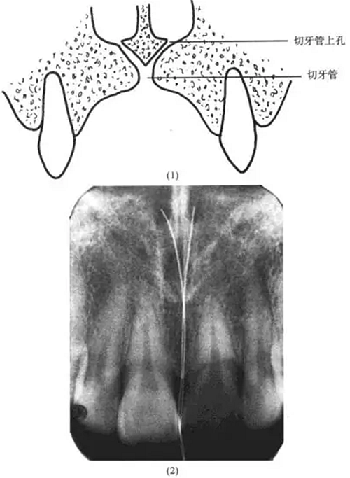 切牙管上孔 切牙管上孔