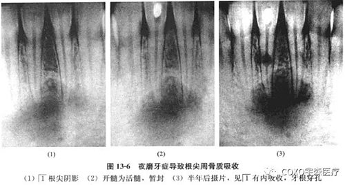 根尖周病與夜磨牙癥 根尖周病與夜磨牙癥