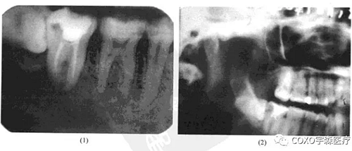根尖周病的鑒別診斷 根尖周病的鑒別診斷