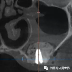 一例失敗上頜竇種植患者的補(bǔ)救 一例失敗上頜竇種植患者的補(bǔ)救