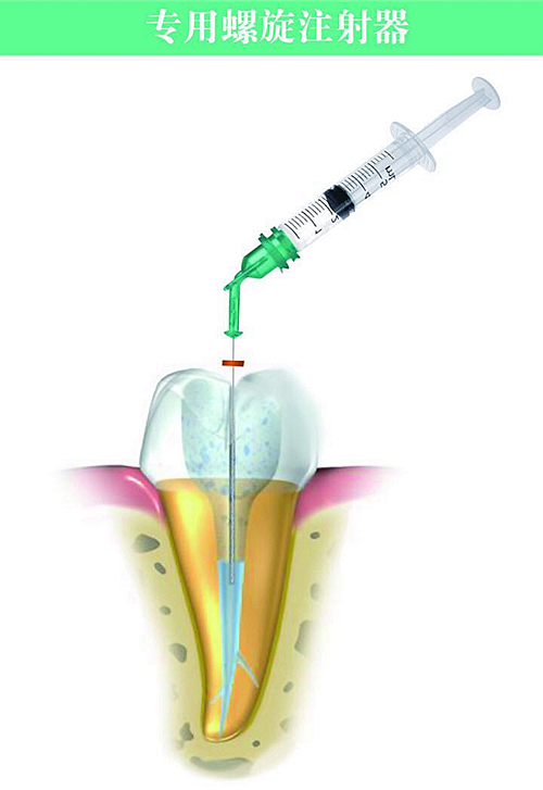廣州蕙帆根管負(fù)壓系統(tǒng) 廣州蕙帆根管負(fù)壓系統(tǒng)