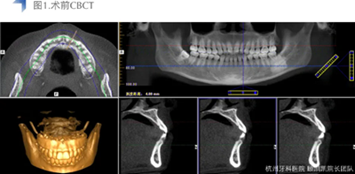 Vitique瓷貼面粘接系統(tǒng)的臨床應用 Vitique瓷貼面粘接系統(tǒng)的臨床應用