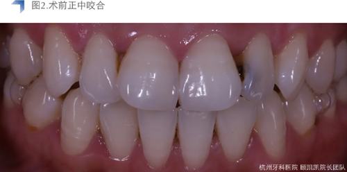 Vitique瓷貼面粘接系統(tǒng)的臨床應用 Vitique瓷貼面粘接系統(tǒng)的臨床應用