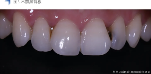 Vitique瓷貼面粘接系統(tǒng)的臨床應用 Vitique瓷貼面粘接系統(tǒng)的臨床應用