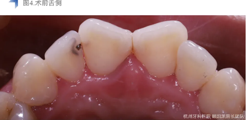 Vitique瓷貼面粘接系統(tǒng)的臨床應用 Vitique瓷貼面粘接系統(tǒng)的臨床應用