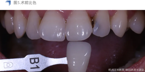 Vitique瓷貼面粘接系統(tǒng)的臨床應用 Vitique瓷貼面粘接系統(tǒng)的臨床應用