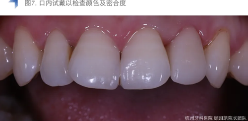 Vitique瓷貼面粘接系統(tǒng)的臨床應用 Vitique瓷貼面粘接系統(tǒng)的臨床應用