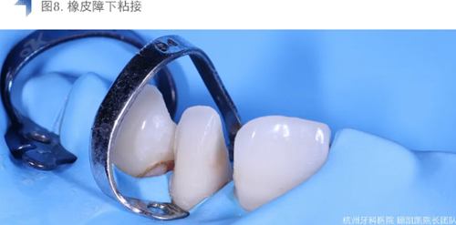 Vitique瓷貼面粘接系統(tǒng)的臨床應用 Vitique瓷貼面粘接系統(tǒng)的臨床應用