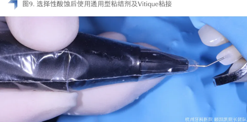 Vitique瓷貼面粘接系統(tǒng)的臨床應用 Vitique瓷貼面粘接系統(tǒng)的臨床應用